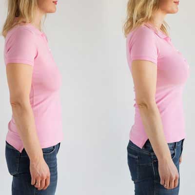 breast lift specialist in secunderabad