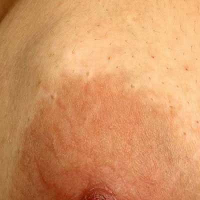 breast lumps treatment in shivaji nagar